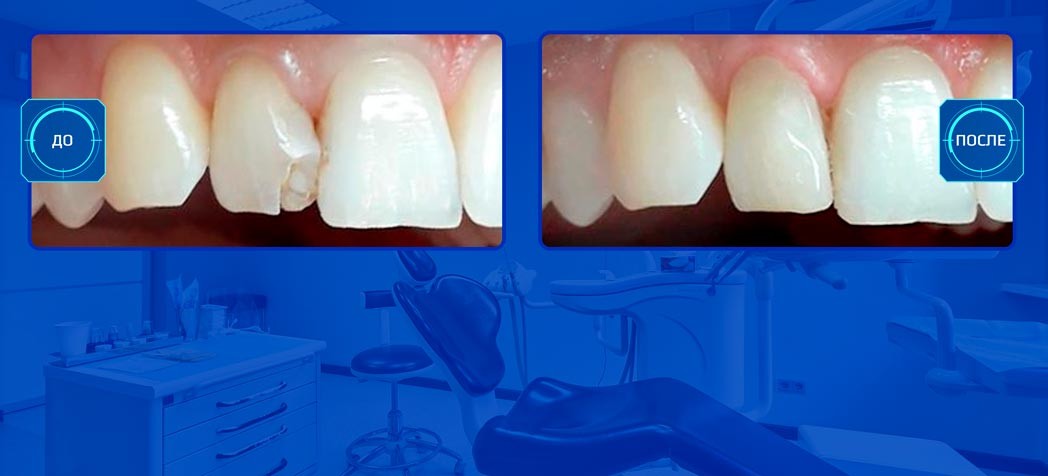 Лечение сколов зуба