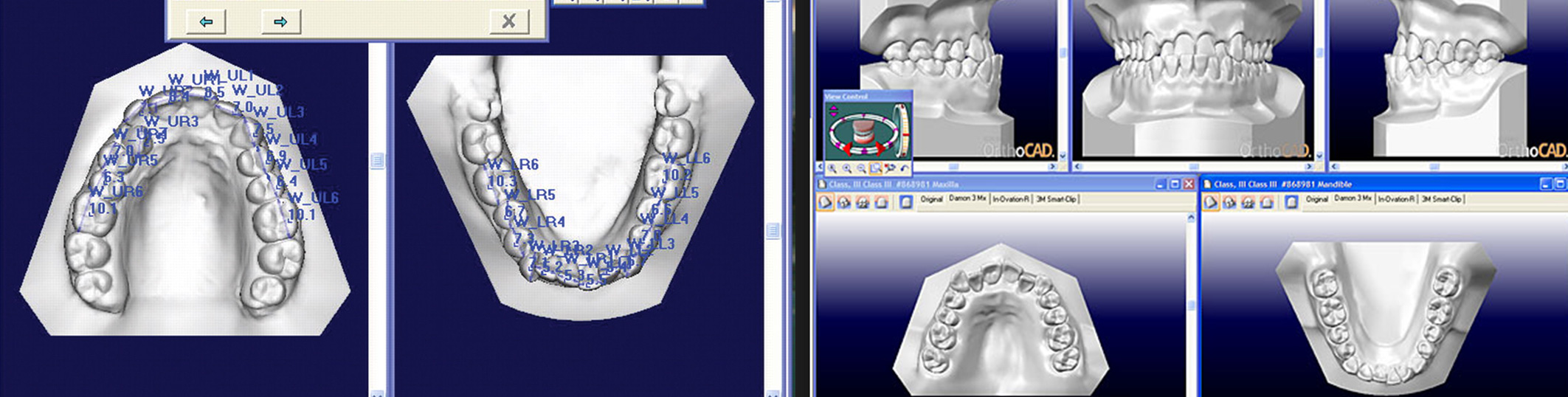 Изображение  Брекеты в Омске - Система OrthoCad - компьютерное 3D - моделирование результата ортодонтического лечения