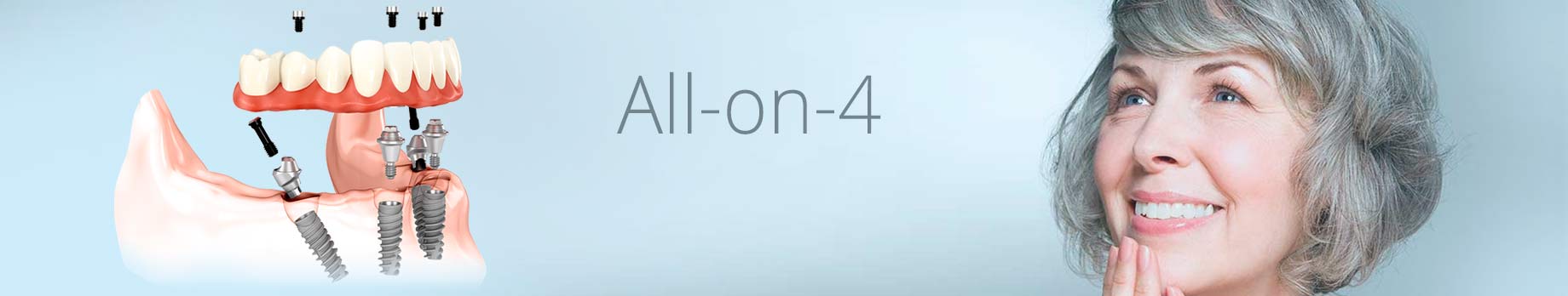 Изображение  All-on-4 - протезирование на 4 имплантатах при отсутствии зубов