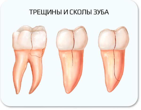 Трещины и сколы зуба