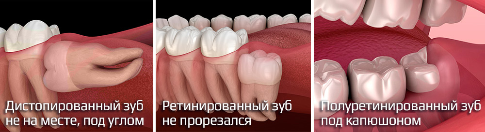 Дистопия и ретенция зубов мудрости
