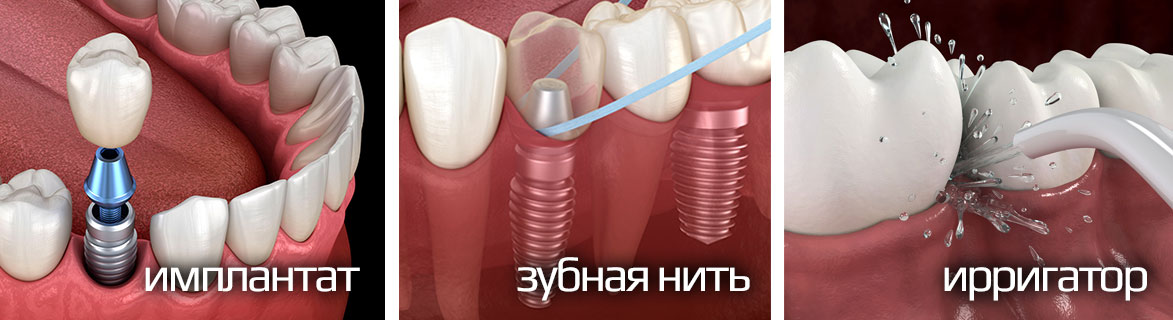 Implant gigiena zub skrit2