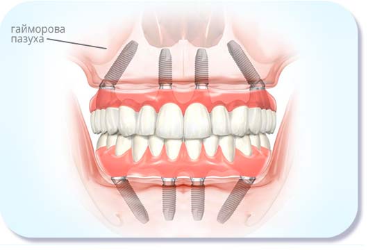 Имплантат входит под углом и не задевает гайморову пазуху