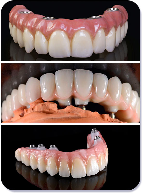 Протезы для All-on-4